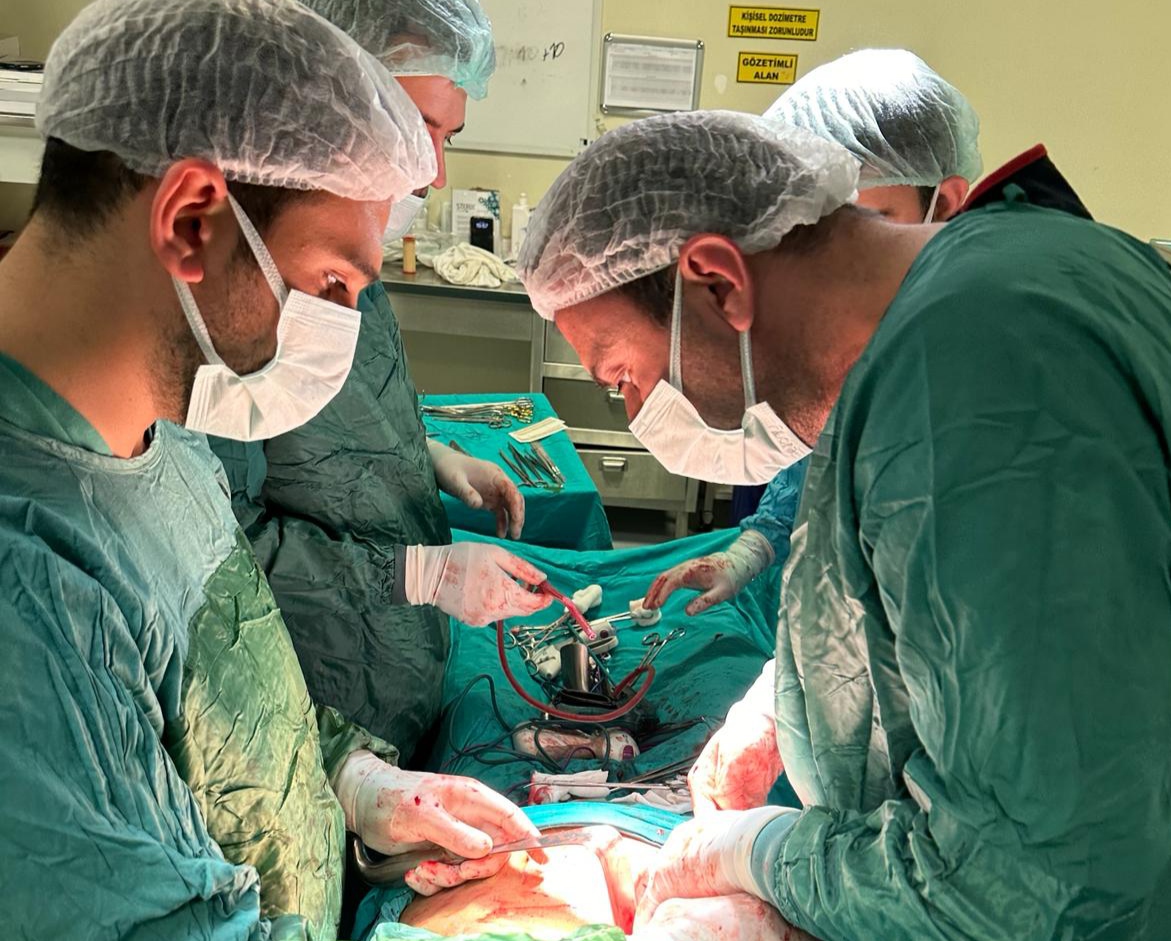 Siirt’te 30 cmlik Dev Enfekte (Amfizematöz) Polikistik Böbrekte Nefrektomi Yapıldı.