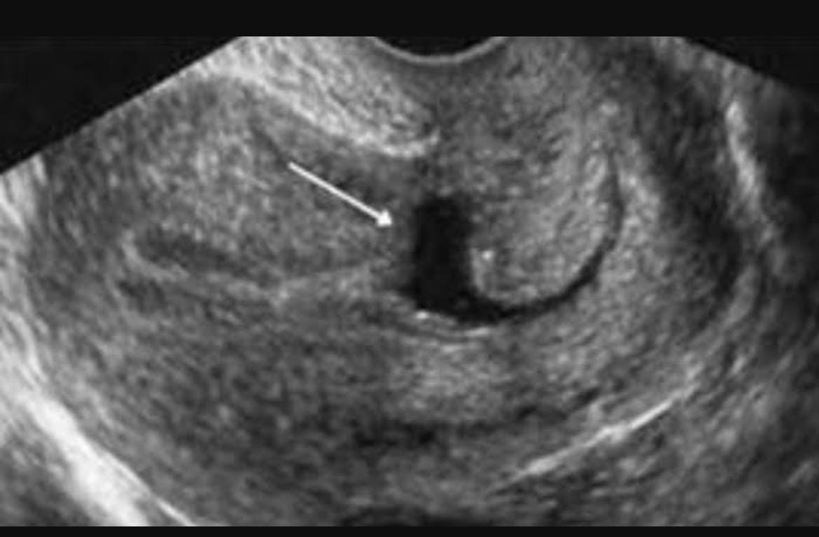 42 YAŞINDAKİ KADIN SAĞLIĞINA KAVUŞTU